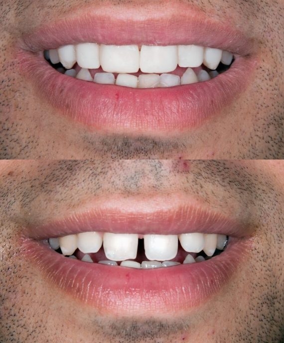 invisalign_mais_facetas