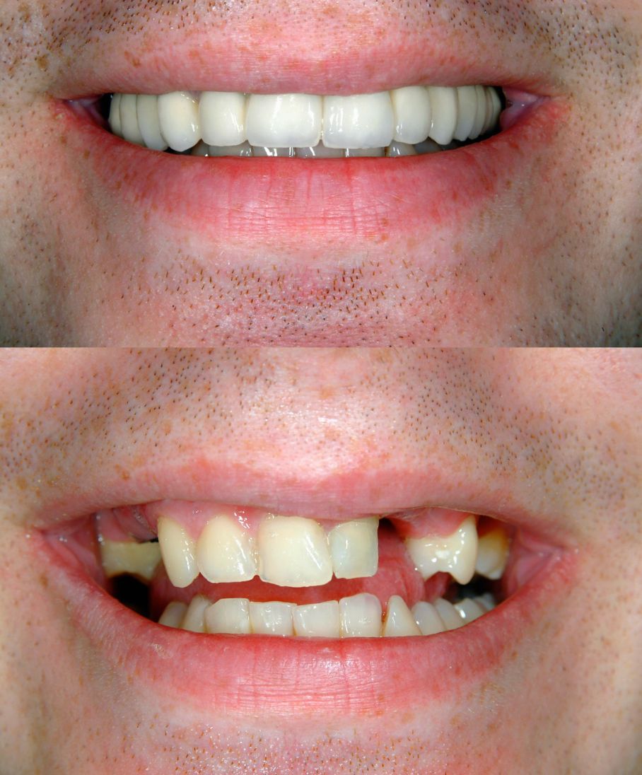 implantes dentarios total